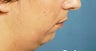 Before and After Chin Procedure