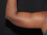 Arm Lift