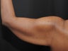 Arm Lift
