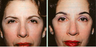 Female Treated for Ptotic Brows Using Endoscopic Forehead Lift