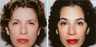 Female Treated for Ptotic Brows Using Endoscopic Forehead Lift