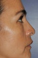 Lower lid blepharoplasty with fat grafting