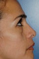 Lower lid blepharoplasty with fat grafting