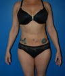 Liposuction abdomen