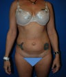 Liposuction abdomen