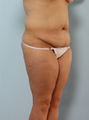 Body Lift