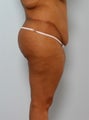 Body Lift