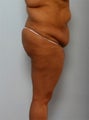 Body Lift
