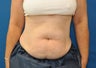 CoolSculpting