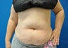 CoolSculpting