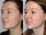28 Year Old Female with Cheek and Chin Implants