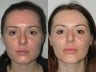 28 Year Old Female with Cheek and Chin Implants