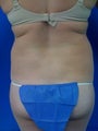 Laser Lipo