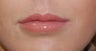 Alloderm Lip Implants