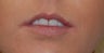 Alloderm Lip Implants