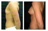 Breast Implants