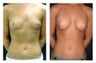 Breast Implants