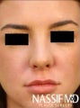 Female Primary Rhinoplasty