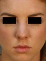 Female Primary Rhinoplasty