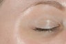 Botox