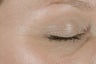 Botox