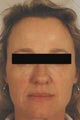 Botox (Dysport) Before & After Photos