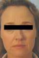 Botox (Dysport) Before & After Photos