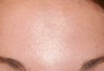Botox treating Forehead wrinkles