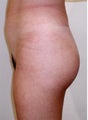 Buttock Augmentation