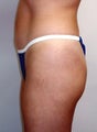 Buttock Augmentation