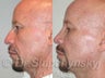 40 Year Old Hispanic Male- Rhinoplasty