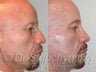 40 Year Old Hispanic Male- Rhinoplasty