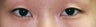 Bilateral Asian Eyelid Surgery
