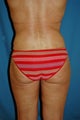 liposuction body