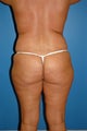 liposuction body