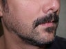Facial Hair Transplant