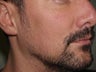 Facial Hair Transplant