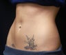 Coolsculpting