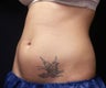 Coolsculpting