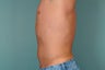 Smart Lipo