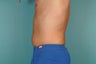 Smart Lipo