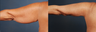 Arm Lift (Brachioplasty)