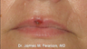 Lip Reconstruction