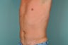 Smart Lipo