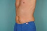 Smart Lipo