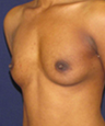 Breast Augmentation