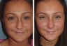 Female Patient Revision Rhinoplasty