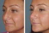 Female Patient Revision Rhinoplasty