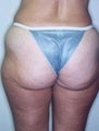 Female patient who underwent a butt lift