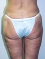 Female patient who underwent a butt lift